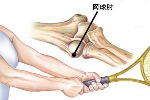 砭術冶療“網球肘”